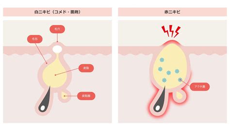 おなにー肌|なぜ、おナニーするとニキビができるのだろうか？科学的に教え。